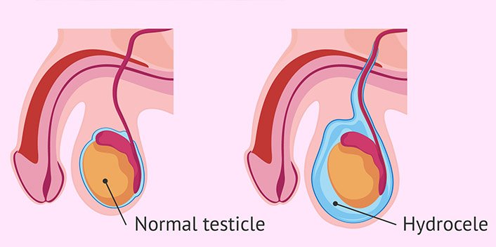 Hydrocele Treatment at Curific Health Care