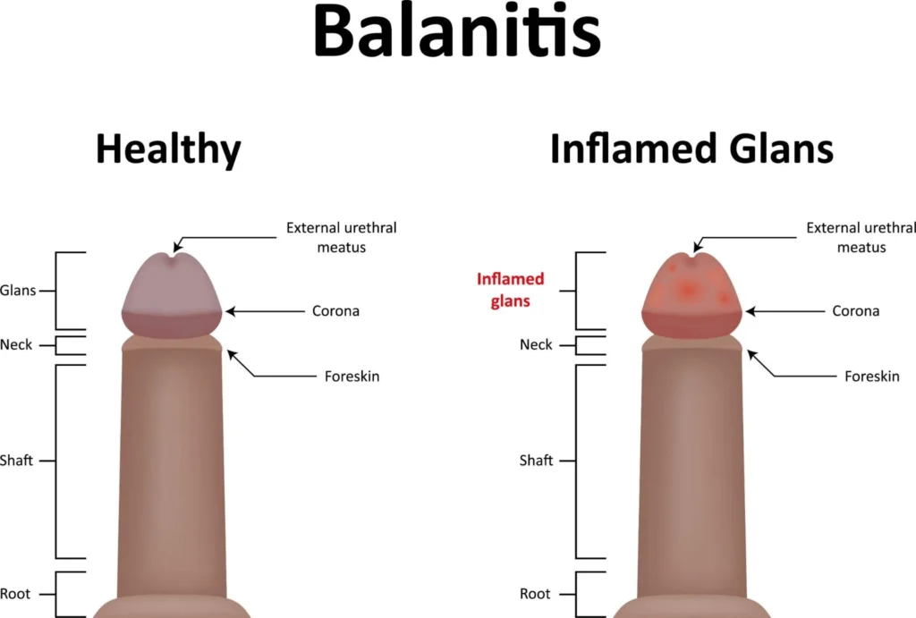Balanitis Treatment at Curific Health Care