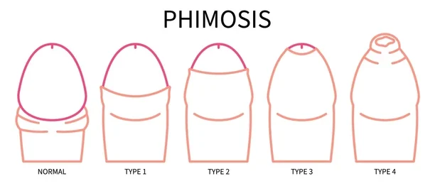 Paraphimosis Surgery at Curific Health Care