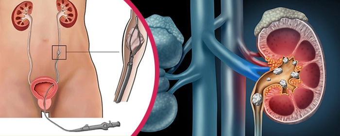 URSL Ureteroscopic Lithotripsy