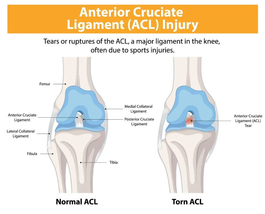 Acl Tear Surgery at Cuirfic Health Care