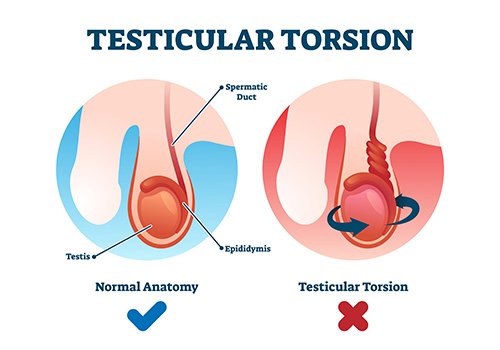 Testicular Torsion Treatment at Curific Health Care