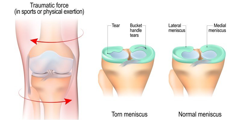 Meniscus Tear Treatment at Curific Health Care