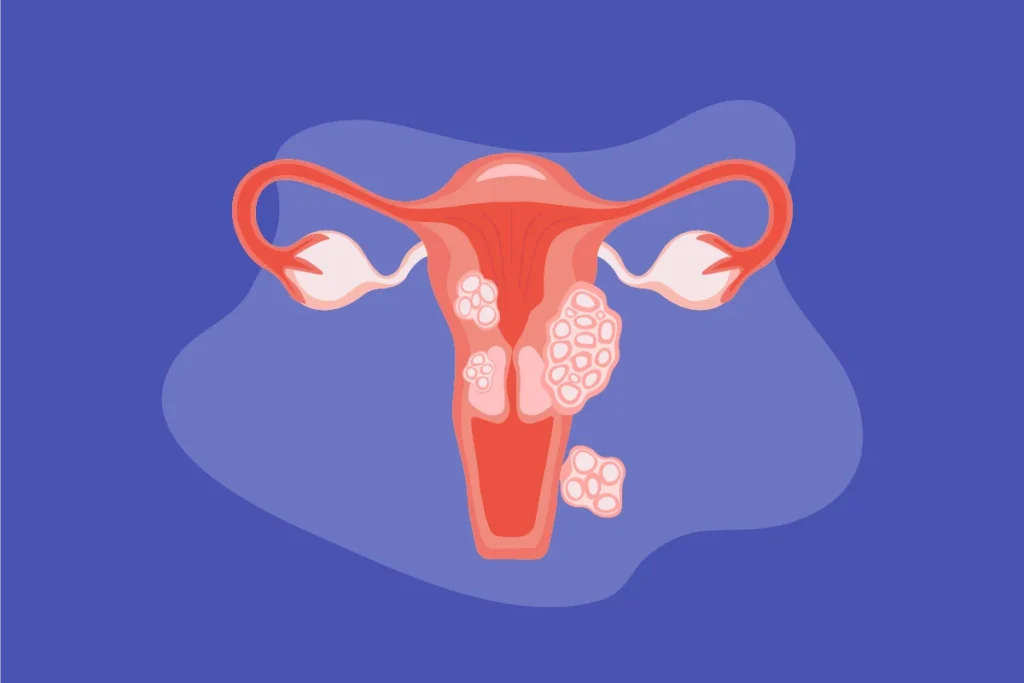 Uterine Fibroids Treatment at Curific Health Care