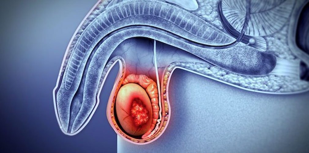 Epididymal Cyst Treatment at Curific Health Care